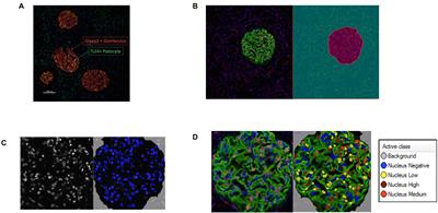 YAP Translocation Precedes Cytoskeletal Rearrangement in Podocyte Stress Response: A Podometric Investigation of Diabetic Nephropathy